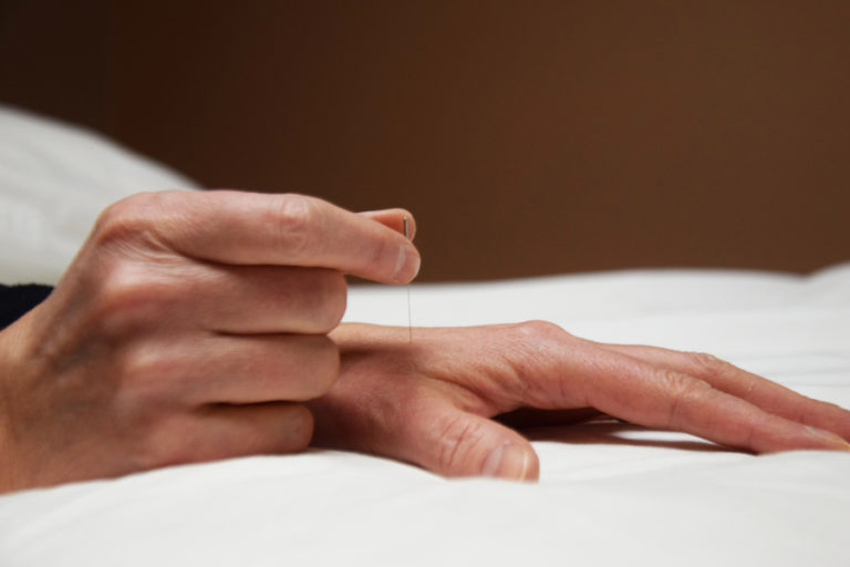 Stephanie Meinhold, owner and practitioner at Camas Acupuncture and Nutrition, places an acupuncture needle in her hand to show how tiny acupuncture needles really are. The ancient Chinese practice can help prevent illness and lead to a less stressful, healthier lifestyle.