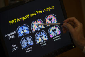 A doctor points to PET scan results that are part of a study on Alzheimer&rsquo;s disease at Georgetown University Hospital on May 19, 2015. Education about brain health can help prevent the disease. (Associated Press files)